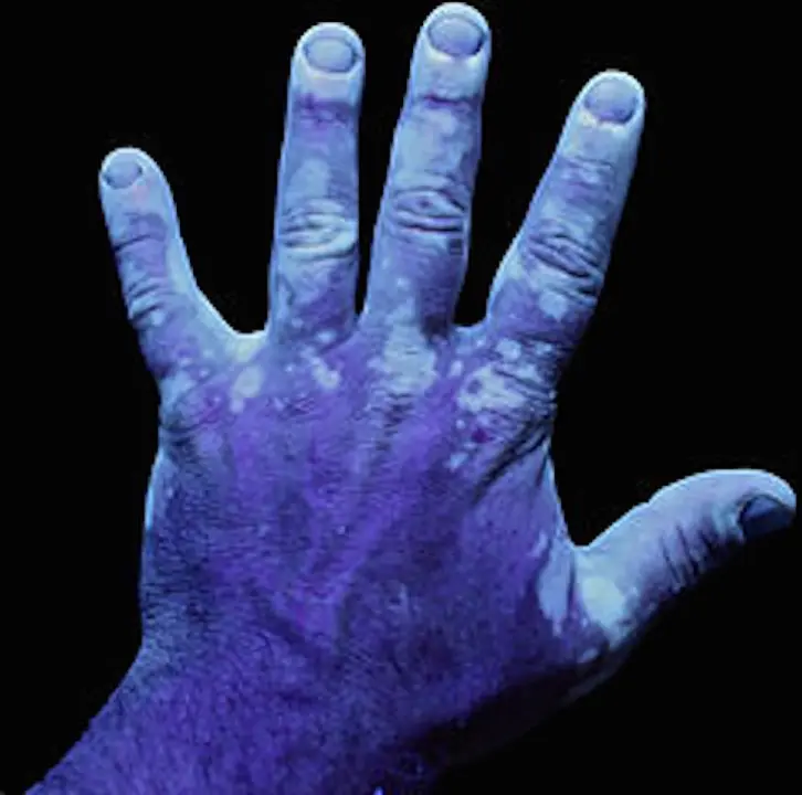 Mano de un paciente de vitiligo.