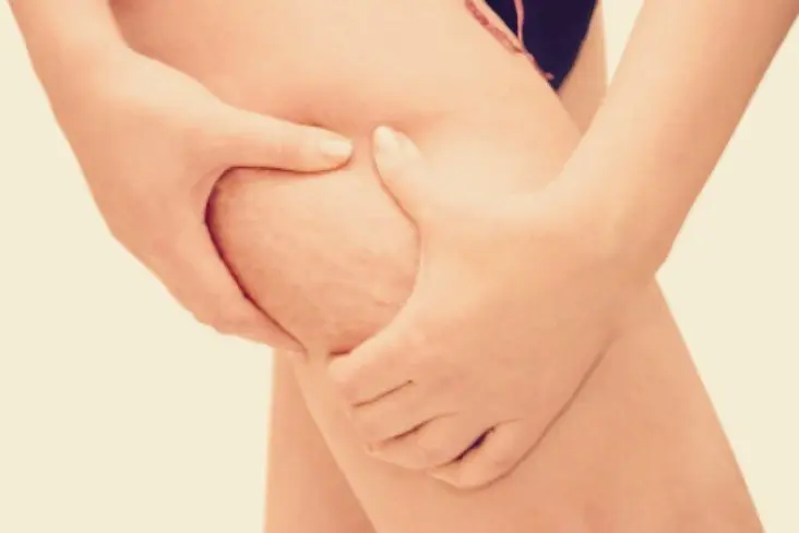 Pierna de mujer con celulitis. / Mundiario