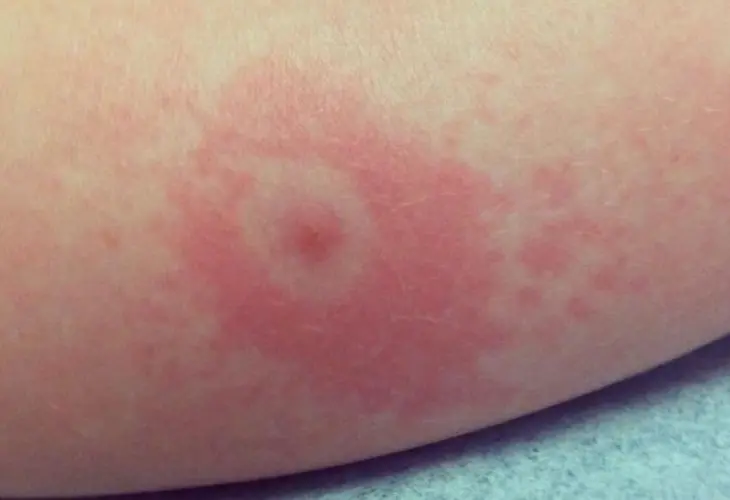 Enfermedad de Lyme. / Pulso.
