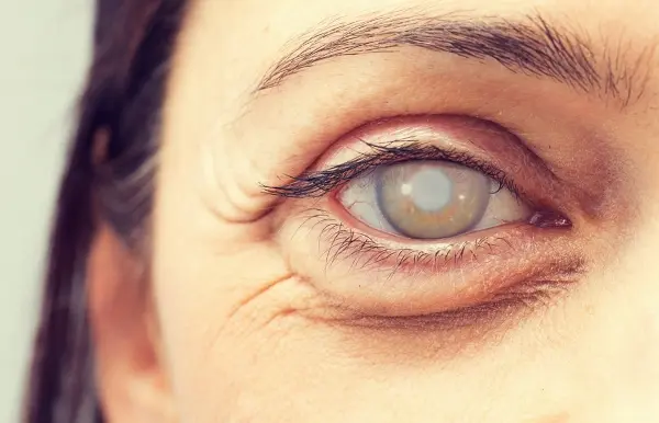Cataratas en el ojo. Pexels.