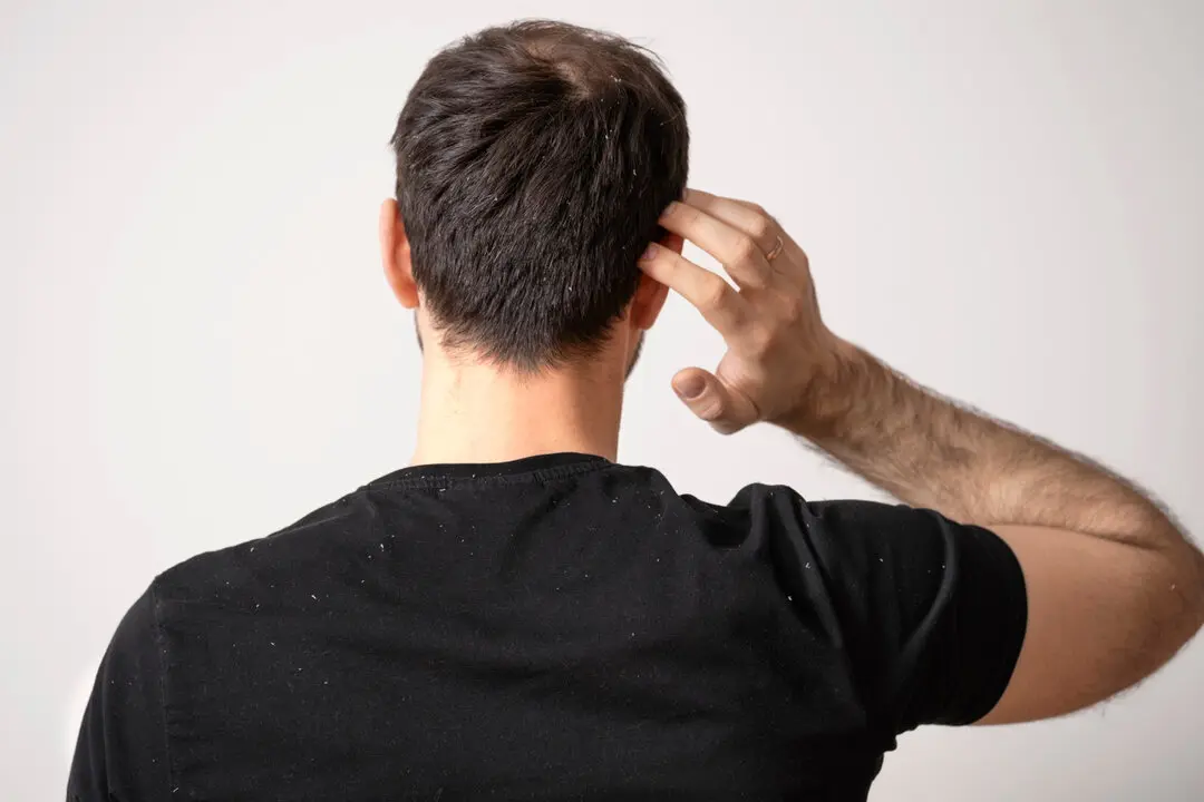 Un hombre con caspa. / Freepik