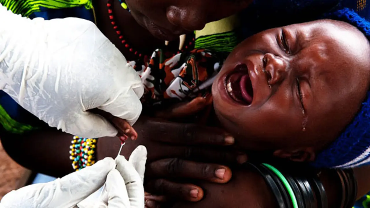 Un ni&ntilde;o enfermo de  malaria. / infanciahoy.com