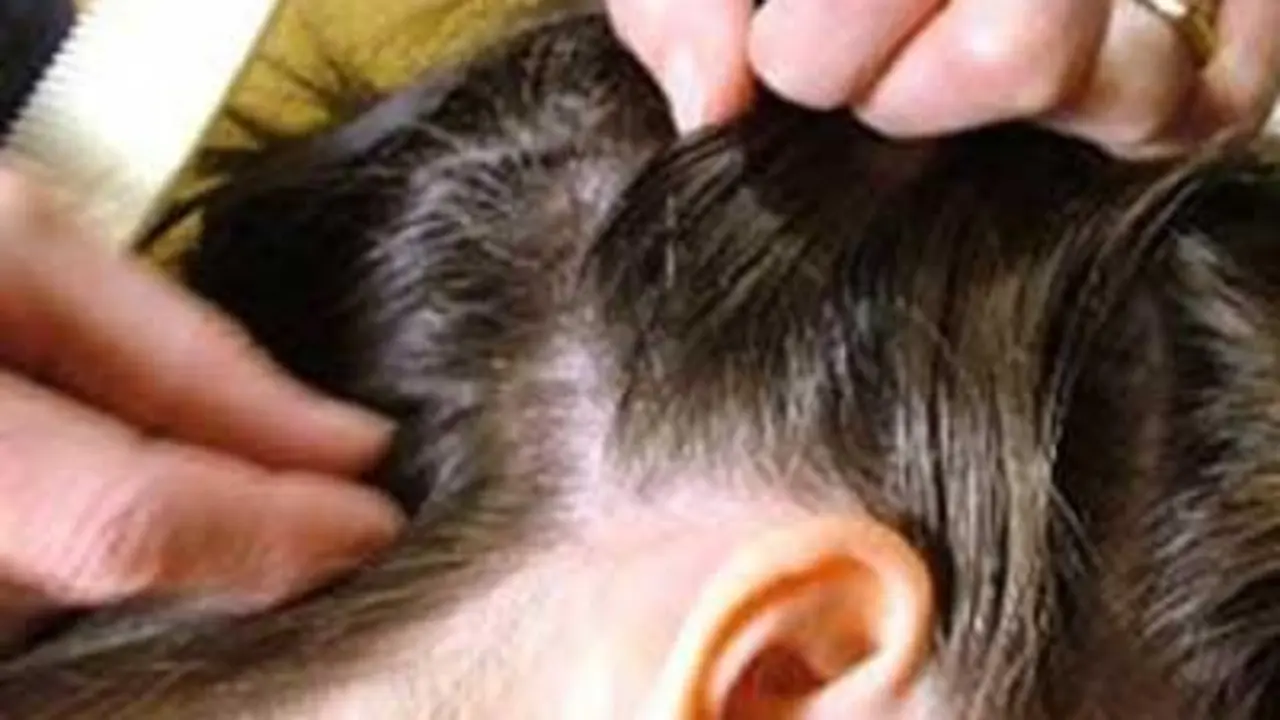 Prevenci&oacute;n de los piojos.