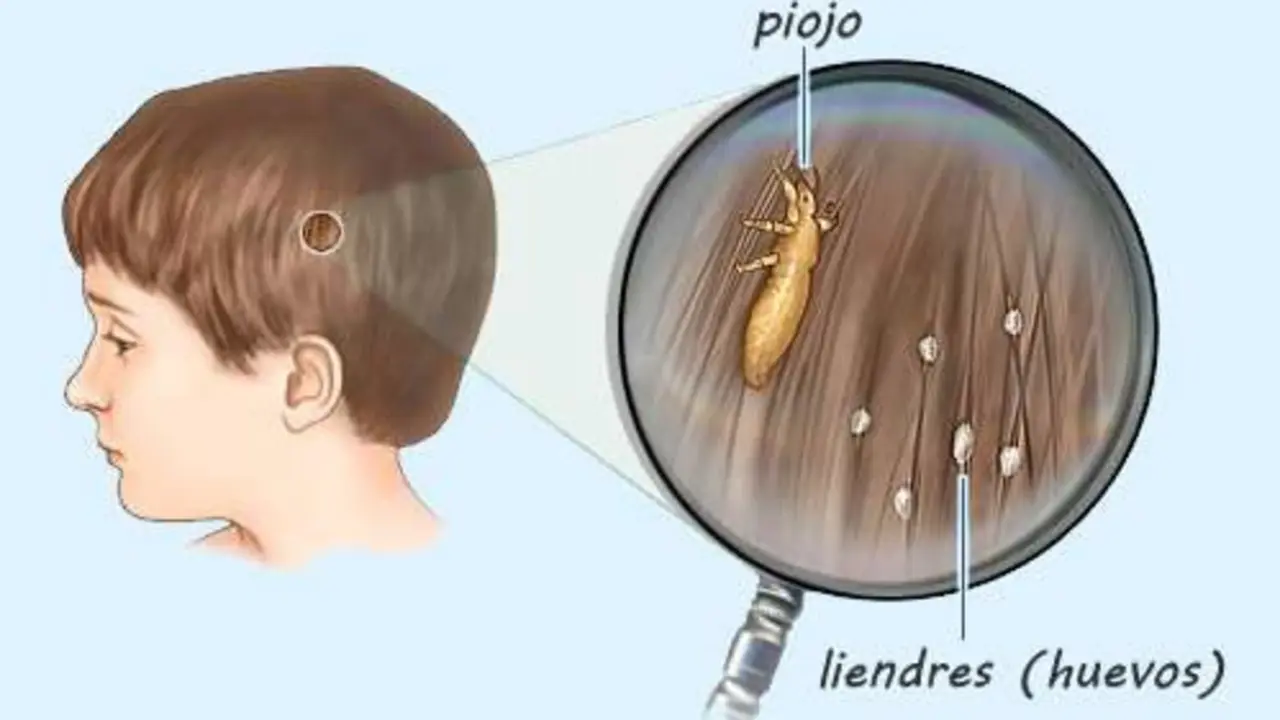 Diferencia_entre_piojos_y_liendres