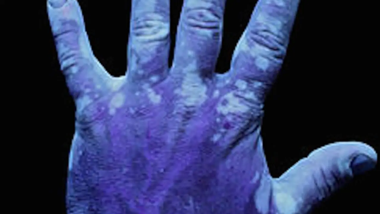 Mano de un paciente de vitiligo.