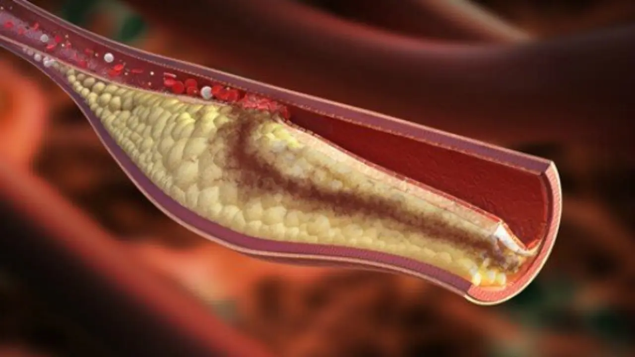 Representaci&oacute;n del colesterol alto. Mejor con Salud