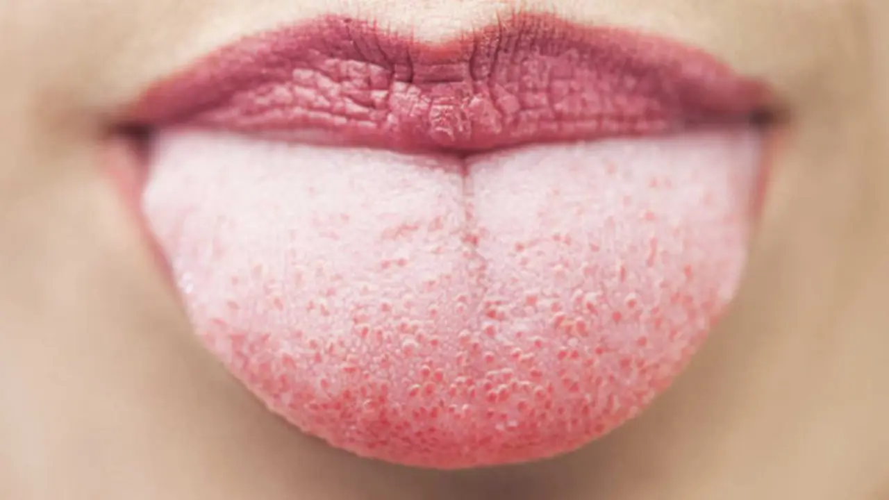 Lengua blanca. / Tusintoma.com