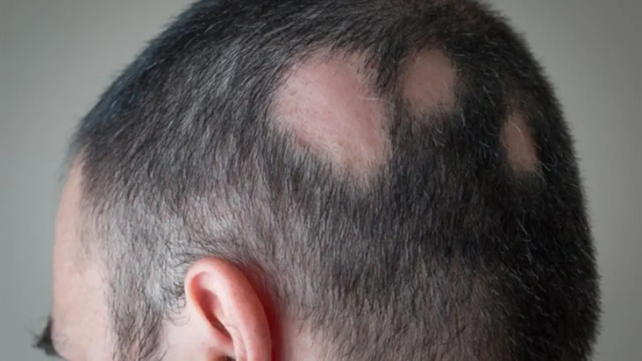 Alopecia. / Infosalus.