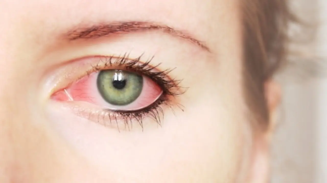 Ojos irritados. / RRSS.