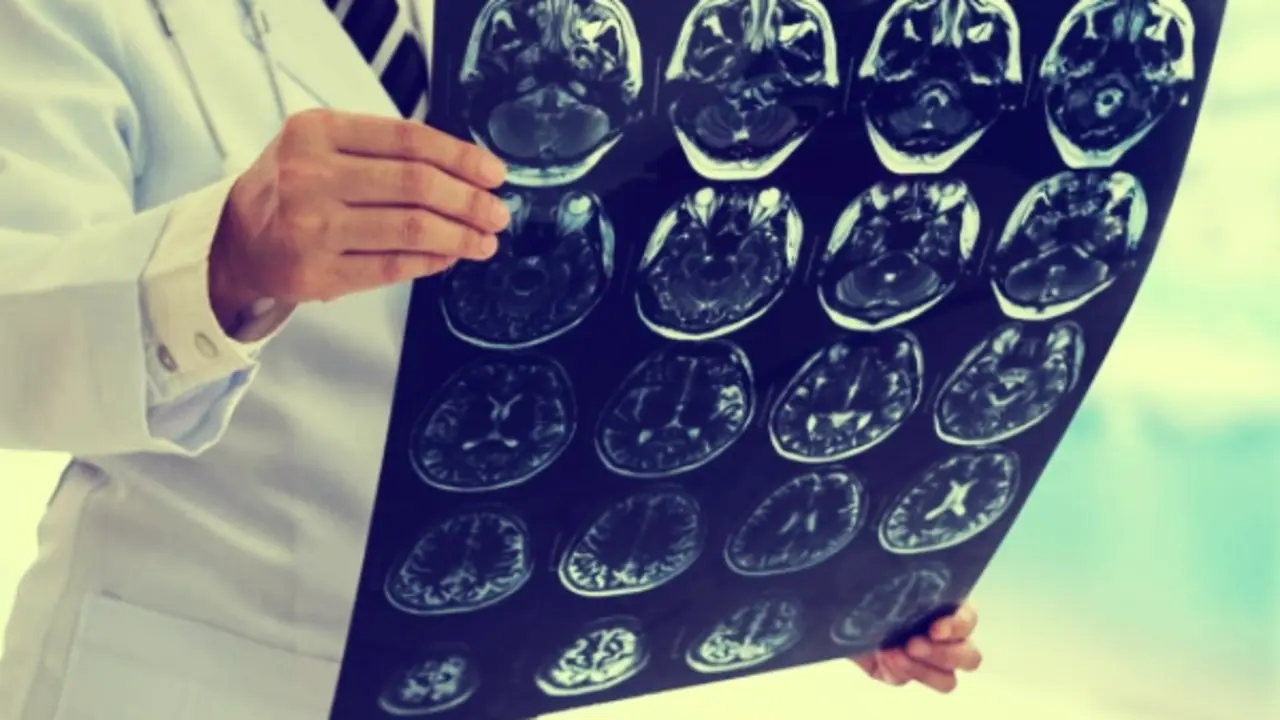 Escaneo cerebral. / RR SS.
