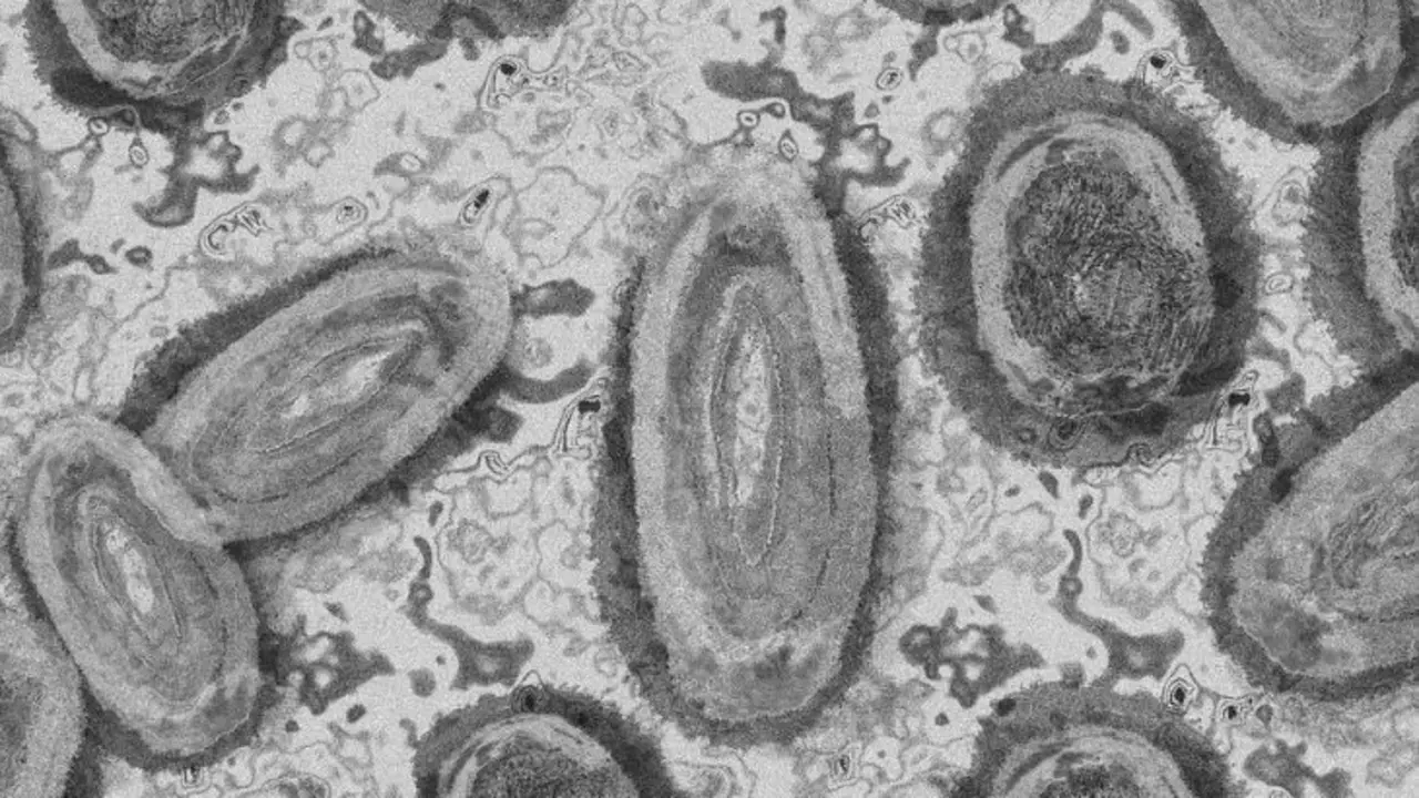 Mpox (viruela del mono). / Pixabay.
