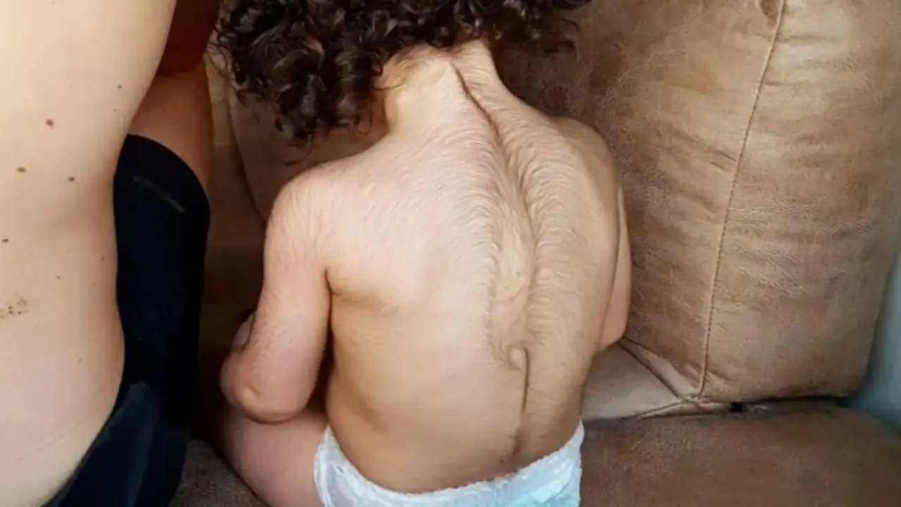Una beb&eacute; con hipetricosis. / RR SS
