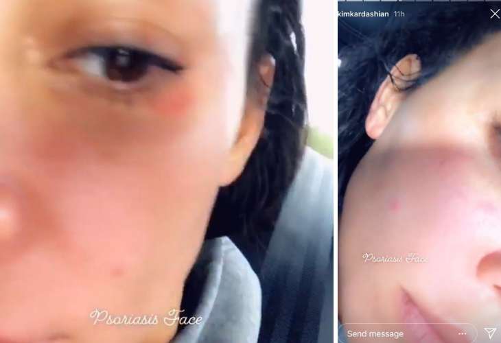 Kim Kardashian se sincera al compartir fotos del brote de la psoriasis en su cara. / RRSS.