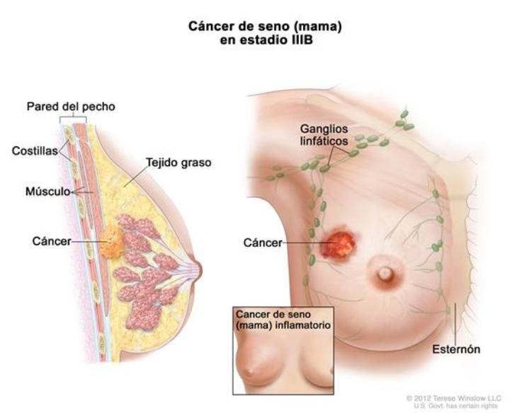 El cáncer de mama es el más común, y representa el 16%, de todos los cánceres femeninos; es más frecuente después de los 50 años 