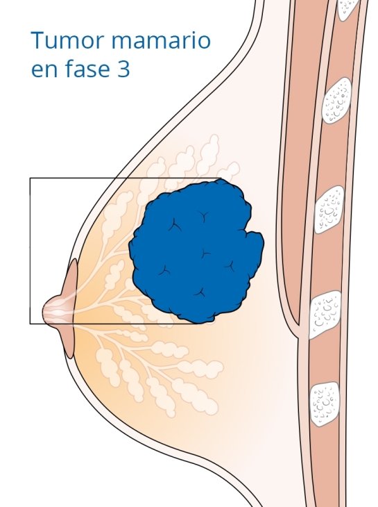 El cáncer de mama es una ECNT -Enfermedad Crónica No Transmisible-  que se origina por la multiplicación rápida y desordenada de las células mamarias
